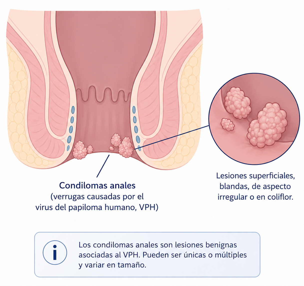 Condilomas anales — VPH