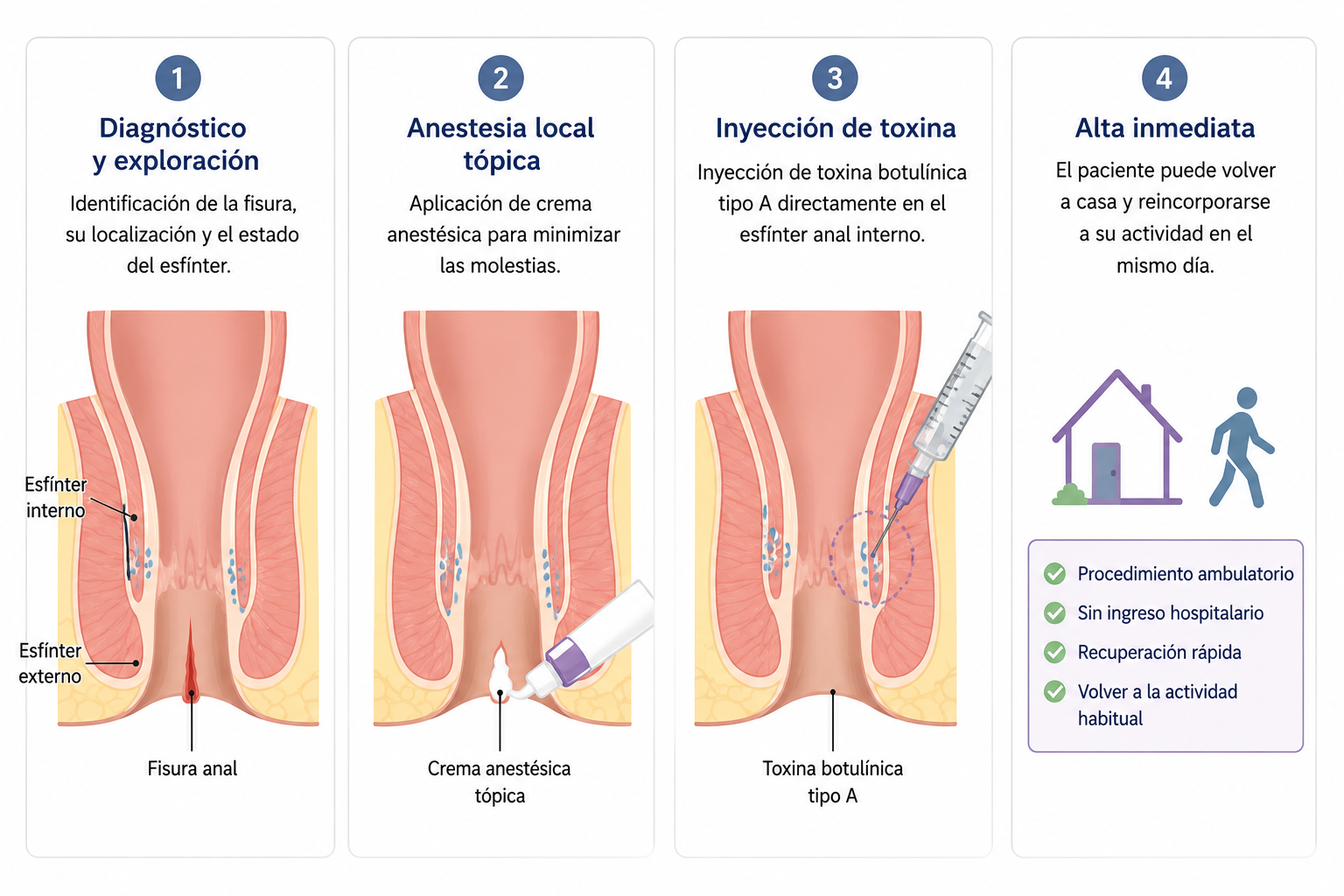 Procedimiento toxina botulínica fisura anal — diagnóstico, anestesia, inyección y alta